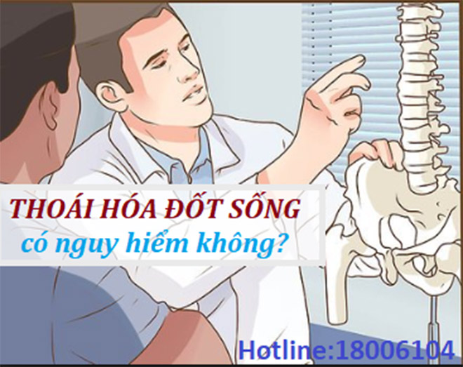 Thoái hóa đốt sống có nguy hiểm không? - 1