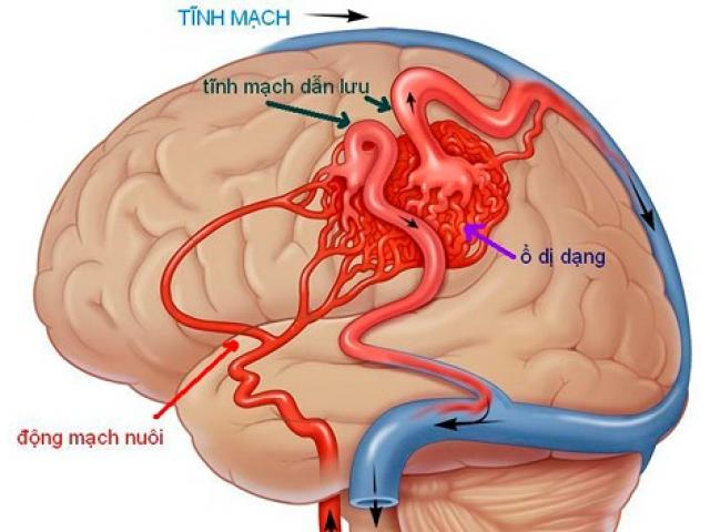 Mắc bệnh này, bạn có nguy cơ đột tử trước tuổi 40