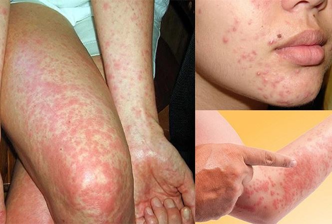 Trời lạnh, có thể chết vì dị ứng thời tiết - 1