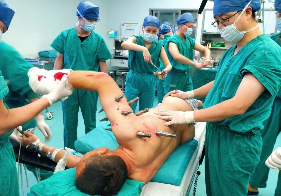 Đang làm việc, bị robot đâm 10 chiếc đinh thép xuyên người - 1