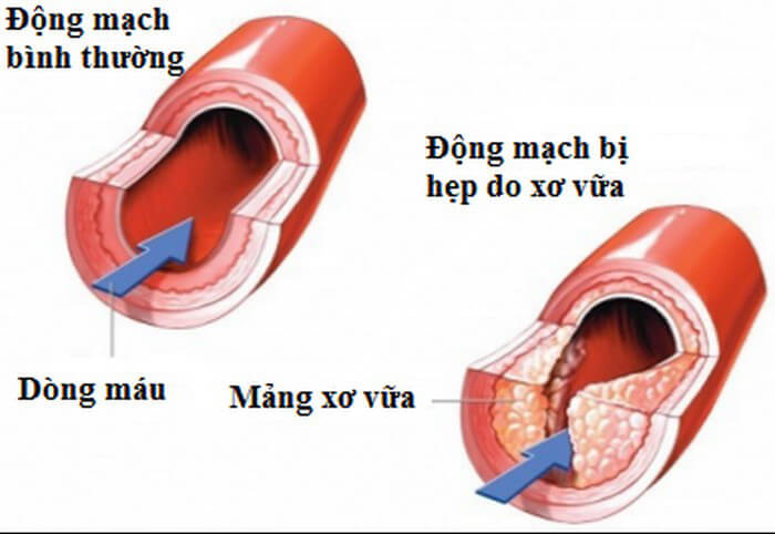 Rối loạn cương dương - Coi chừng bệnh tim mạch - 1