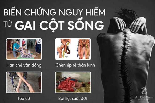 Gai cột sống: Nguyên nhân, triệu chứng và cách chữa nhờ bài thuốc toàn diện - 1