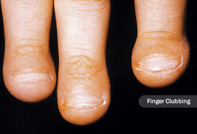 1. Ngón tay mập hơn bình thường: Một số khối u phổi tạo ra các hóa chất giống như hormone. Một trong số chúng đẩy nhiều máu và chất lỏng đến các mô trong ngón tay, vì vậy chúng trông dày hơn hoặc lớn hơn bình thường. Da bên cạnh móng tay có vẻ sáng bóng hoặc móng tay có thể cong hơn bình thường khi bạn nhìn chúng từ bên cạnh. Nó không phổ biến, nhưng hình dạng ngón tay có liên quan mạnh mẽ đến ung thư phổi: khoảng 80% những người mắc bệnh có dấu hiệu này.