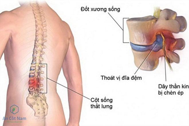 Đau thắt lưng: 5 bệnh nguy hiểm ẩn sau triệu chứng cơn đau lưng - 2