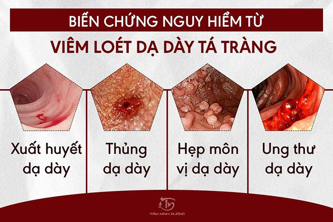 Viêm loét dạ dày tá tràng là gì và cách chữa bệnh hiệu quả - 2