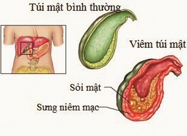 Sỏi túi hay gặp ở tuổi trung niên nhưng đang có xu hướng gặp ở người trẻ. Ảnh internet