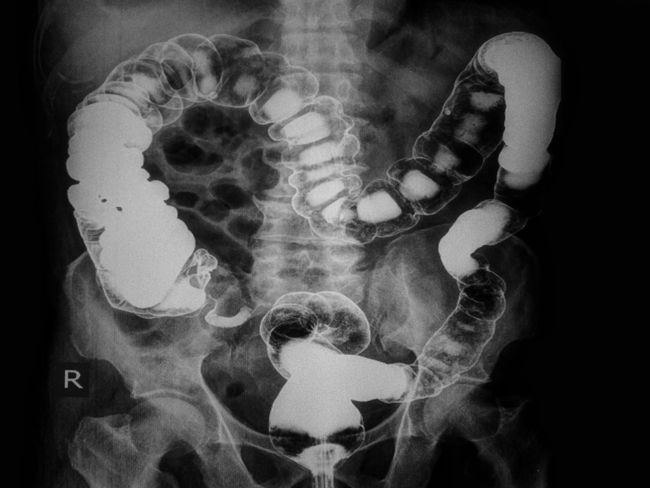 10. Sàng lọc nguy cơ ung thư: Sàng lọc ung thư trực tràng có thể phát hiện sớm được polyp, tiền thân của khối u sớm, thậm chí nhiều năm trước khi chúng phát triển thành ung thư. Các bác sĩ sau đó có thể loại bỏ ung thư trực tràng bằng cách loại bỏ các polyp.
