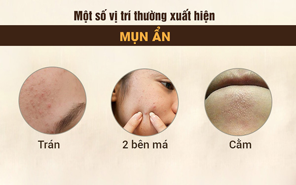 Trị mụn ẩn và những nguyên tắc cần tuân thủ để mụn không tái phát - 2