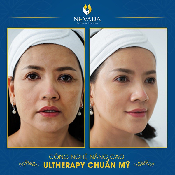 Diễn viên Ngọc Trinh trẻ hóa da nhờ công nghệ Ultherapy chuẩn Mỹ