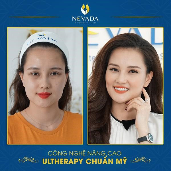 MC Huyền Châu sử dụng Ultherapy và kết quả