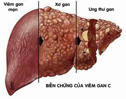 Căn bệnh khiến 30 triệu người Việt mắc, nguyên nhân không thể ngờ - 1