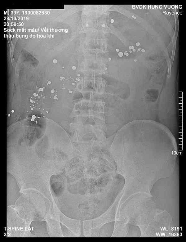 Hình ảnh chụp X quang thể hiện 15 viên đạn