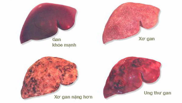 Giám đốc BV K hướng dẫn cách phòng bệnh ung thư có tỷ lệ mắc mới nhiều nhất tại Việt Nam - 1