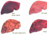 Sức khỏe đời sống - Giám đốc BV K hướng dẫn cách phòng bệnh ung thư có tỷ lệ mắc mới nhiều nhất tại Việt Nam