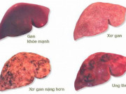 Sức khỏe đời sống - 5 thủ phạm “quật ngã” lá gan của người Việt