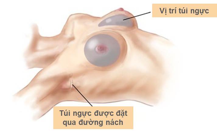 Vị trí tháo túi ngực ở hố nách.