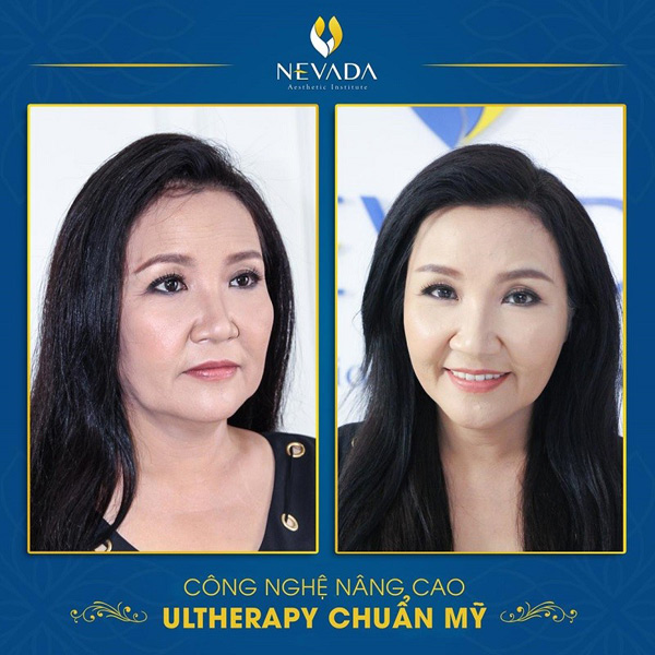 Nghệ sĩ Ngân Quỳnh trẻ hóa da bằng công nghệ Ultherapy chuẩn Mỹ