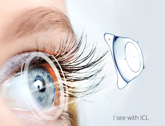 Phakic ICL tối ưu cho mắt cận thị nặng, giác mạc mỏng
