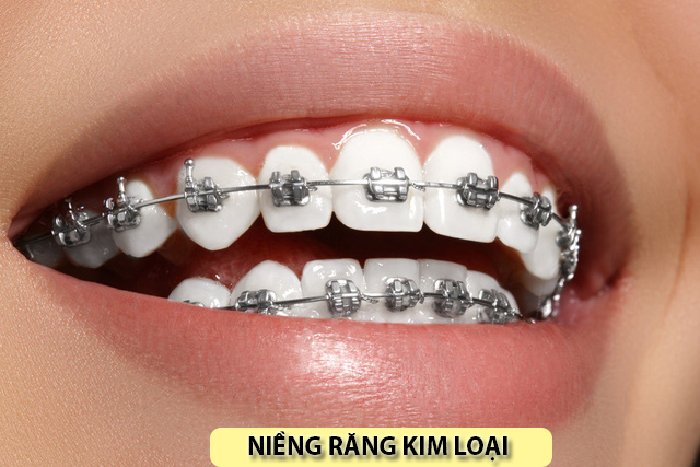 Niềng răng độ tuổi nào nên làm, thời gian niềng và những lưu ý - 1