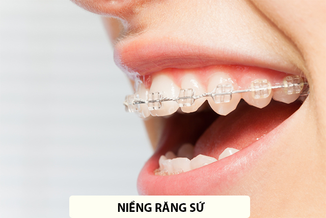 Niềng răng độ tuổi nào nên làm, thời gian niềng và những lưu ý - 2