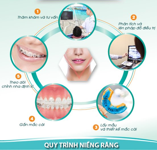 Niềng răng độ tuổi nào nên làm, thời gian niềng và những lưu ý - 9