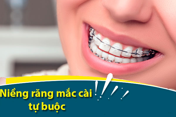 Niềng răng độ tuổi nào nên làm, thời gian niềng và những lưu ý - 4