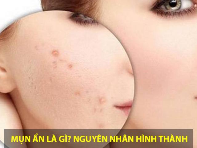 Cách trị mụn ẩn tại nhà hiệu quả từ nguyên liệu tự nhiên