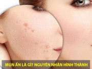 Làm đẹp - Cách trị mụn ẩn tại nhà hiệu quả từ nguyên liệu tự nhiên