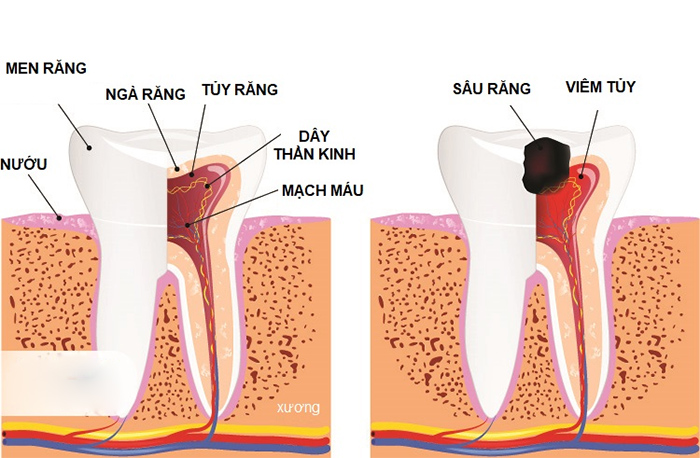 Bọc răng sứ là gì? Những tác hại và biến chứng nguy hiểm khi bọc răng sứ - 2