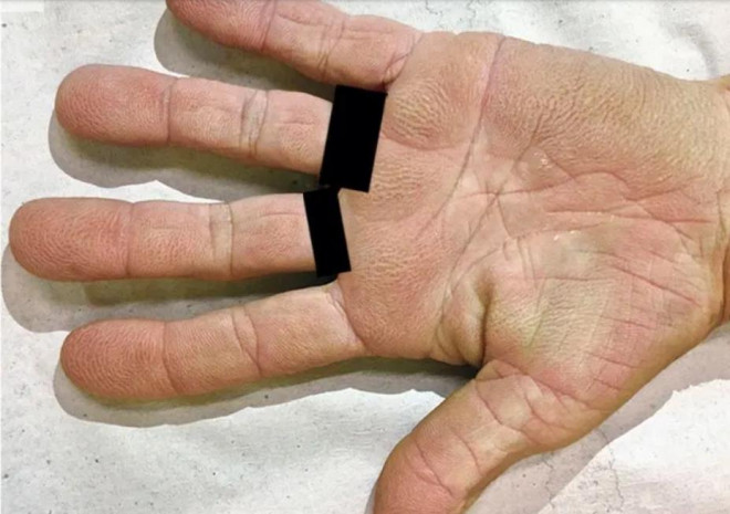 Da tay nữ bệnh nhân có biểu hiện "lòng bàn tay dạ dày"