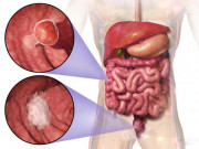 Sức khỏe đời sống - Muốn đề phòng căn bệnh &quot;sát thủ&quot; ung thư ruột kết, phải biết rõ những điều này