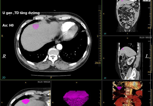 Hình ảnh chụp CT 128 dãy ổ bụng bệnh nhân nam (hình ảnh khối u gan được bôi màu tím).