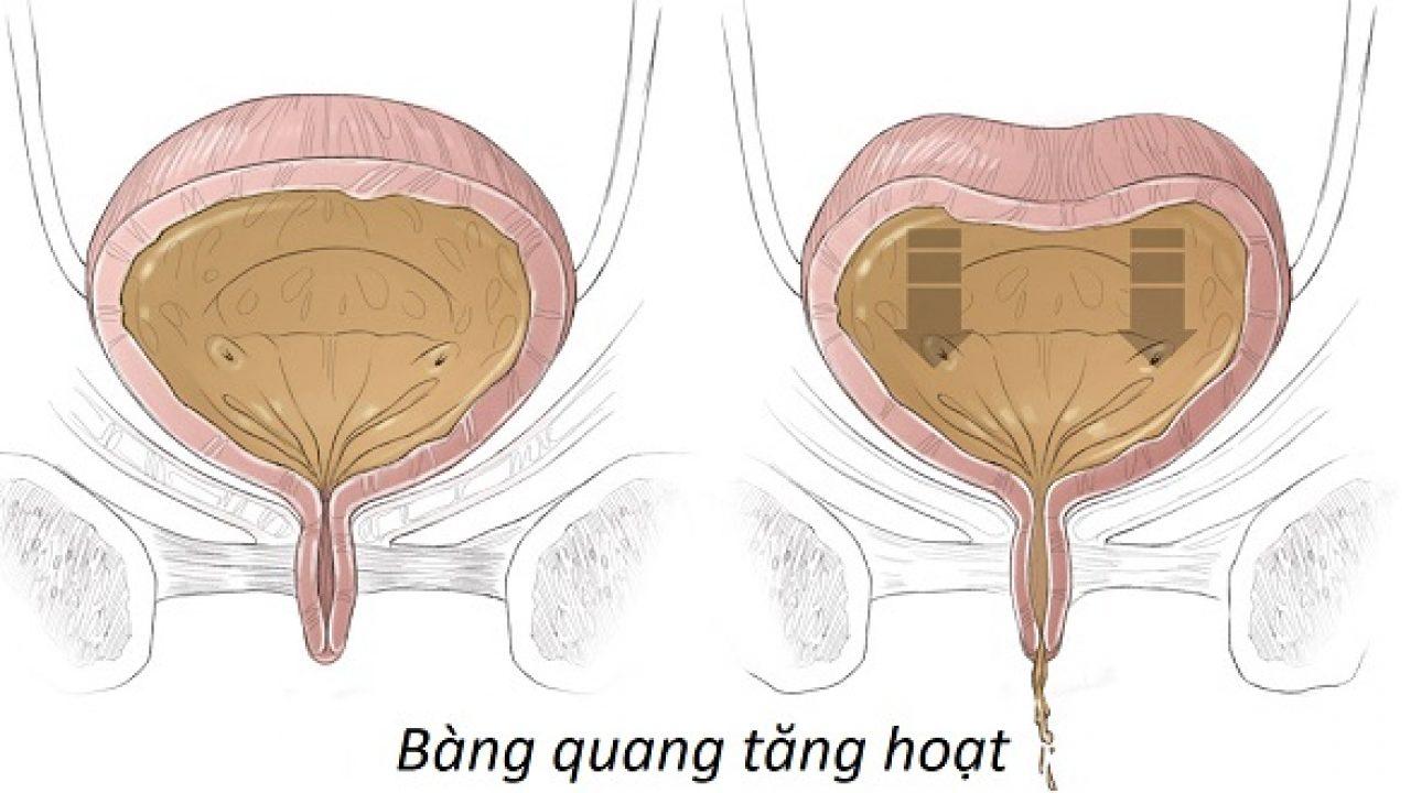 Bàng quang kích thích (tăng hoạt) là nguyên nhân gây tiểu đêm nhiều lần