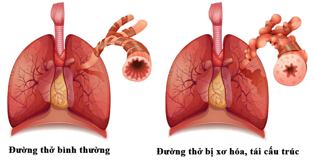 Tái cấu trúc đường thở gây ho có đờm kéo dài