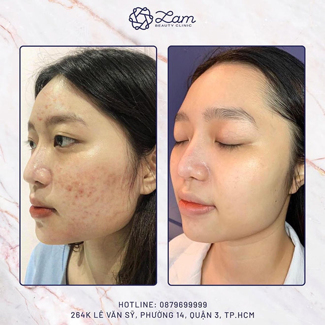 Liệu trình Juveni x20 mang lại hiệu quả trong điều trị mụn