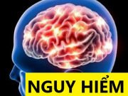 Sức khỏe đời sống - Đau đầu giật nhói khi thay đổi thời tiết, stress, tới chu kỳ: Chứng bệnh nguy hiểm ít người biết rõ!