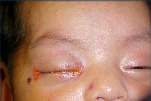 Biểu hiện của bệnh lậu là mắt đỏ,&nbsp;trên bờ mi chảy dịch mủ màu vàng, đóng vảy tiết. (Ảnh minh họa)