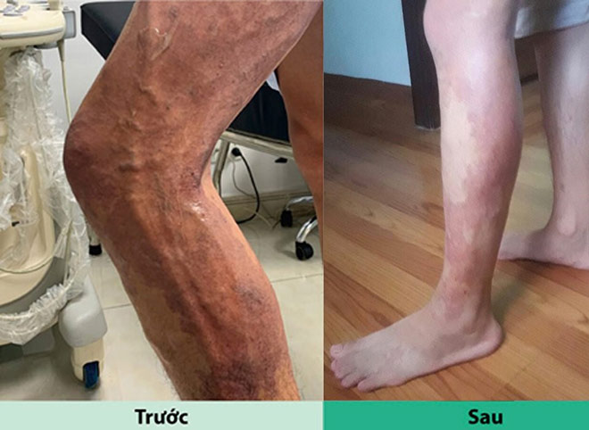 Hình ảnh đôi chân bị rối loạn mạch máu trước và sau phẫu thuật của bệnh nhân N.T.H.(Bệnh viện FV cung cấp)