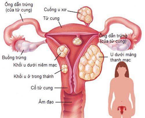 Những điểm u xơ tử cung hay mọc. Ảnh minh họa.