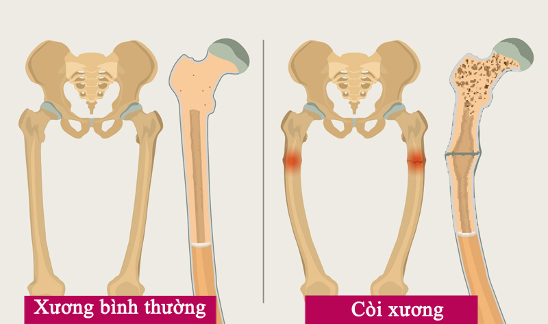 Còi xương – thủ phạm khiến trẻ thấp còi, chậm lớn, viêm phổi, bố mẹ chớ coi thường! - 1