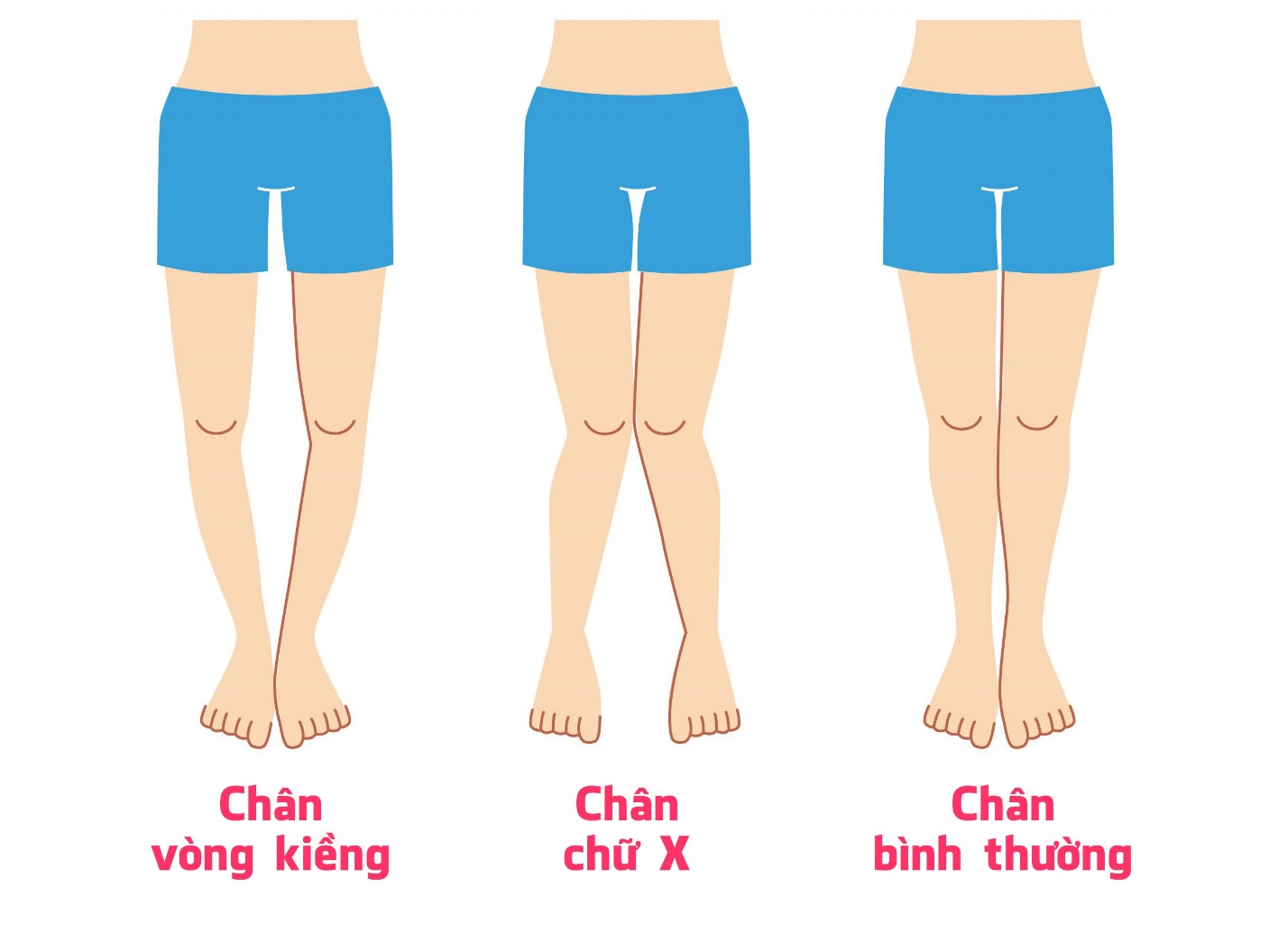 Dấu hiệu nhận biết trẻ còi xương ở chân