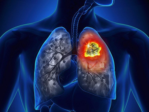 Cảnh báo 5 dấu hiệu không ngờ đến của ung thư phổi - 1