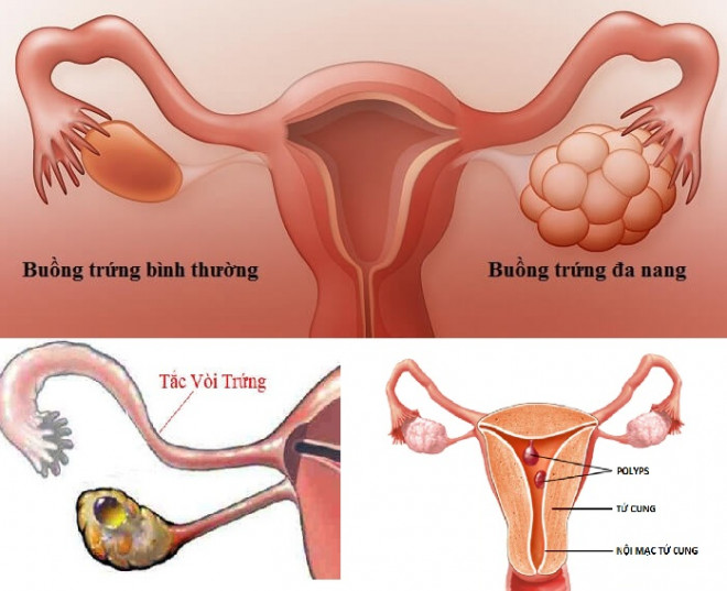 Tắc vòi trứng, buồng trứng đa nang là nguyên nhân gây vô sinh, hiếm muộn.