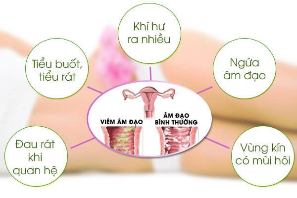 Biểu hiện của viêm âm đạo.