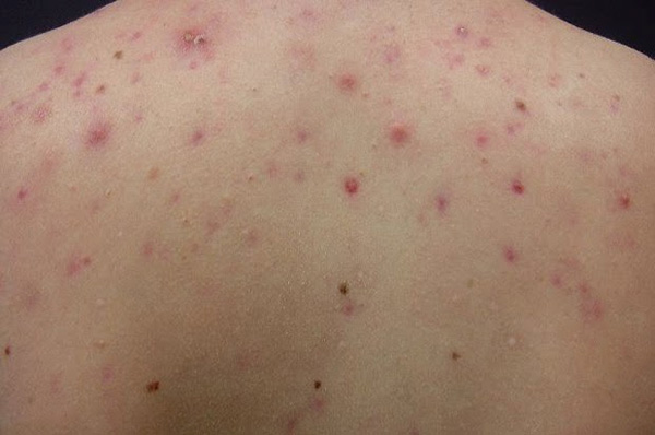 Gan nhiễm độc - 4 Nguyên nhân chính và điều trị hiệu quả 2 Gan Nhiễm Độc - Nguyên Nhân, Triệu Chứng và Cách Điều Trị Hiệu Quả
