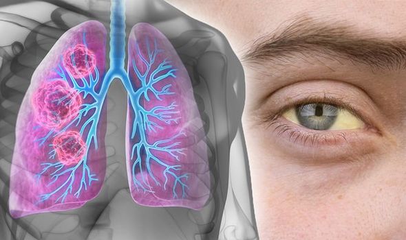 Dấu hiệu nhận biết ung thư phổi: Vàng mắt và vàng da (Nguồn: GETTY)