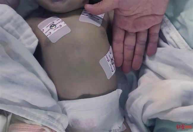 Hình ảnh bé sơ sinh tím tái khi nhập viện