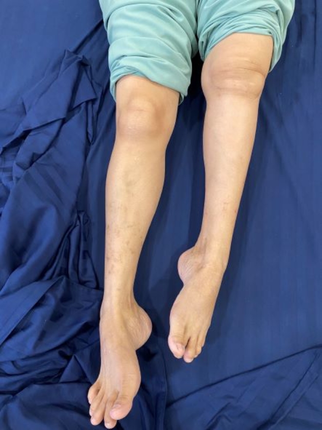 Hình ảnh bệnh nhân trước khi mổ, chân trái ngắn hơn chân phải khoảng 10cm, bệnh nhân không thể đi lại bằng chân trái