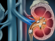 Sức khỏe đời sống - Những thói quen ăn uống tai hại khiến 2 quả thận tích đầy sỏi