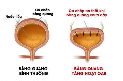 “Rùng mình” tiểu gấp khi nghe tiếng nước chảy - Cẩn thận bệnh nguy hiểm này - 2